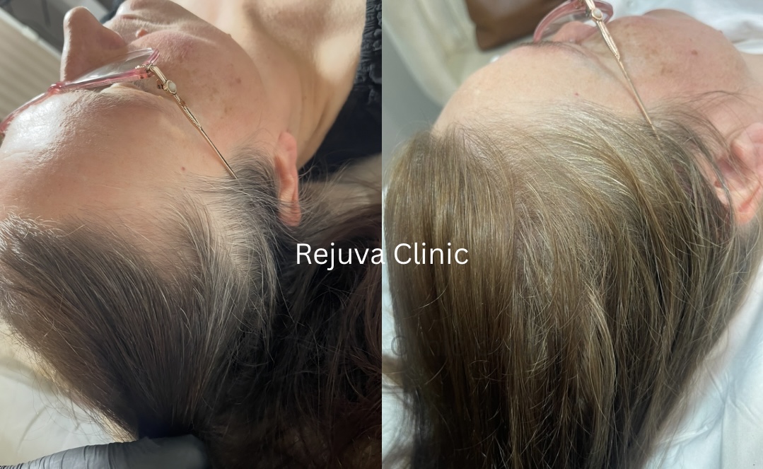 Rejuva hair treatment result
